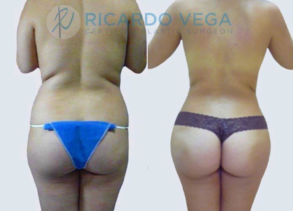 Butt implants - Dr Ricardo Vega Website