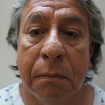 Butt implants - Dr Ricardo Vega Website