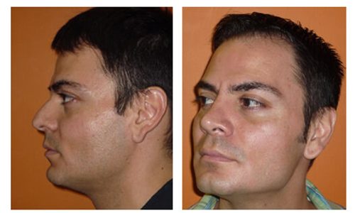 rinoplastia003_2 rinoplastia003_2